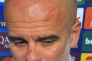◆悲報◆フェイエに3点差追いつかれたペップ・グアルディオラ、顔面かきむしりすぎて傷だらけ