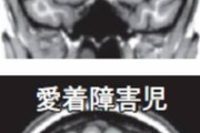 【衝撃】精神科医「ネグレクトの影響で後天的に発達障害になることもある」