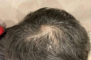 【朗報】ワイの髪の毛、復活する（※画像あり）