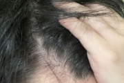 ワイ、朝シャンで86本の髪の毛が抜ける（※画像あり）