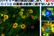 アルツハイマーの原因、脳細胞に咲く毒の花が原因だった可能性をＮＹＵが発表