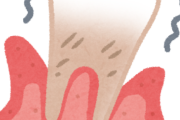 【悲報】どんだけ頑張って歯磨きしても歯周病が止まらない