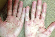 Twitter民「大人の手足口病　体験記」→想像以上に怖い