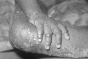 【悲報】サル痘感染者の41%、HIVにも感染していたＷＷＷＷＷＷＷＷＷＷＷＷＷＷＷＷＷＷＷＷＷＷＷ