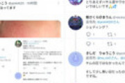 反ワクさん、子供の顔が腫れあがるも「ワクチン接種者との接触」が原因と断定 ⇒ 診療を拒否し反ワク御用達の「ハサル水」で治すと豪語