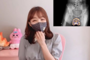 【悲報】大事故映像が話題になった女子ライダーYouTuber、股関節が折れて人工関節の後遺症が残る模様（画像あり）