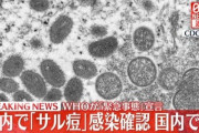 【悲報】サル痘､日本上陸　東京都在住の30代男性が感染