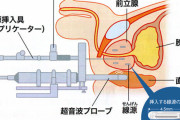 【観覧注意】※画像※ 前立腺がんの治療、怖すぎる