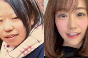 【整形美女】「整形への執着でなんとか生きていた」400万円の手術で女性が得られたものとは？