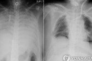 コロナ後遺症の日本人女性、夫と息子の肺を移植…世界初＝韓国の反応