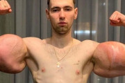 超人ハルクに憧れたロシア人、腕切断の危機に・・・