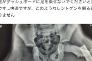 (ヽ´ん`)「骨盤に石破いるじゃん」