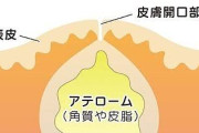 粉瘤など良性腫瘍ができる方！