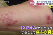 【緊急】『帯状疱疹』、ガチで地獄の苦しみ