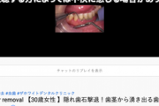 【朗報】歯石を取るだけの動画、なぜか2ヶ月で3569万回も視聴されてしまう…