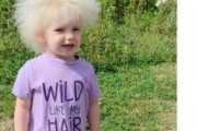 まるでタンポポの綿毛のよう「櫛でとかせない頭髪症候群」の3歳女児（英）
