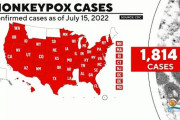 元米FDA長官「米国はサル痘の抑え込みに失敗した…もう遅いかも」米国でサル痘急拡大[海外の反応]