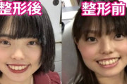 【画像】お笑いトリオ「ぼる塾はるか」さん、整形していたｗｗｗｗｗｗｗｗｗｗｗｗｗｗｗｗｗｗｗｗｗｗ