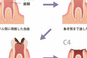 【恐怖】歯医者「c1、c3、c3、c4、c2、c2」←これどういう意味や…？