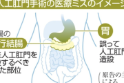【速報】医師、ミスって胃に人工肛門をつける → 遺族が提訴