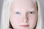 【画像】アルビノとオッドアイを併発した少女ｗｗｗｗｗｗｗｗｗｗｗｗｗｗｗｗｗｗｗｗｗｗｗｗｗｗｗ