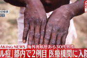 【サル痘】海外渡航歴のある男性、サル痘持ち帰る　国内二例目