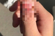 【閲覧注意】親指を噛み過ぎ”ガン”になった女性！？親指の形がグロすぎる・・・