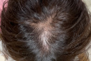 【朗報】俺のハゲ、治るwww