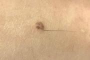 【速報】ホクロから生える謎の毛、ハゲ治療の新たな鍵だった…