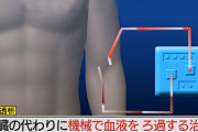 人工透析、キツすぎる「週3通院して下さい。4時間かかります。サボると死にます」